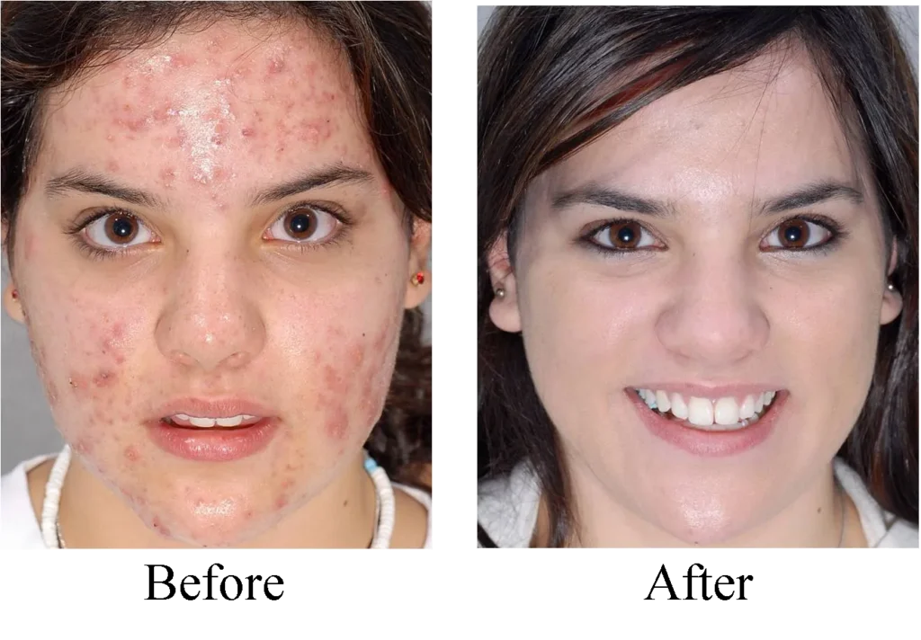 Acne cream