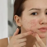 acne cream
