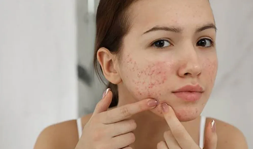 acne cream